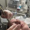Microdermabrasion machine being used on a client